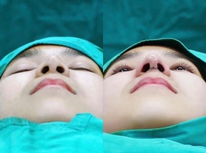 Nâng mũi nội soi