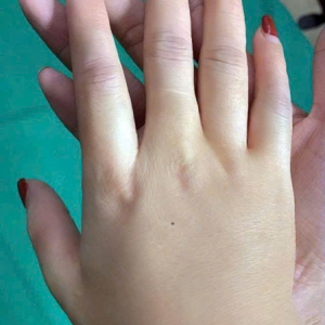 Tiêm chất làm đẹp